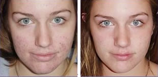 Natural Acne treatment | All Information About Acne | Page 4